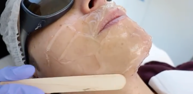 Depilación Láser Permanente Soprano ICE Facial | Láser Soprano